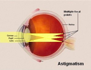 Astigmatism